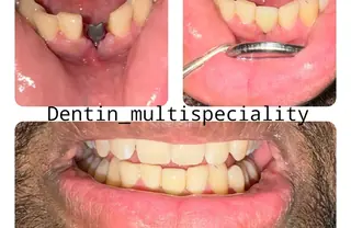 Dental crowns before and after result at DENTIN Dental Clinic, HSR Layout