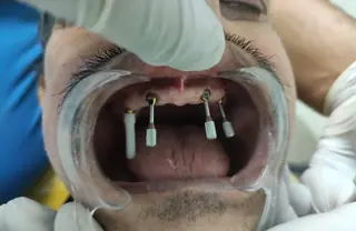Dental implant placement procedure at DENTIN Dental Clinic, HSR Layout