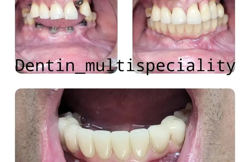 Dental implants before and after result at DENTIN Dental Clinic, HSR Layout Bengaluru