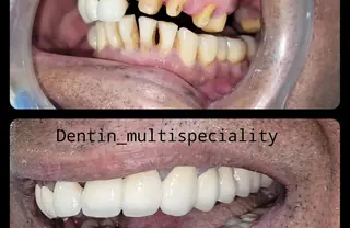 Full arch dental implant restoration before and after at DENTIN, HSR Layout