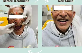 Full arch rehabilitation with PFM crowns at DENTIN Dental Clinic, HSR Layout