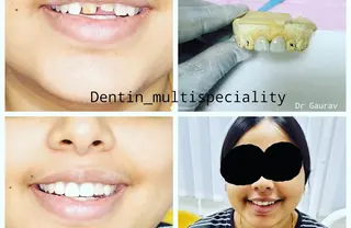 Full mouth dental implant treatment case at DENTIN Dental Clinic, HSR Layout