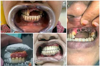Full-mouth implant rehabilitation clinical case at DENTIN Multispeciality Dental Clinic & Implant Center, HSR Layout
