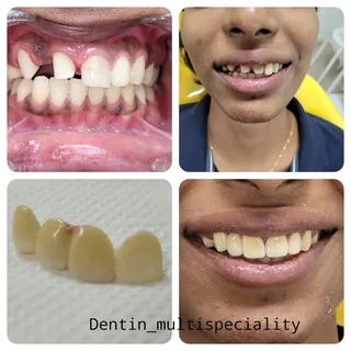 Dental implant treatment planning at DENTIN Multispeciality Dental Clinic & Implant Center, HSR Layout Bengaluru