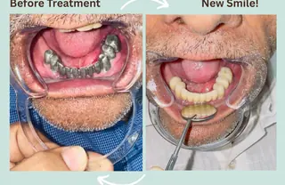 Metal framework smile restoration at DENTIN Dental Clinic, HSR Layout