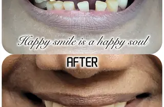 Smile makeover before and after at DENTIN Dental Clinic, HSR Layout