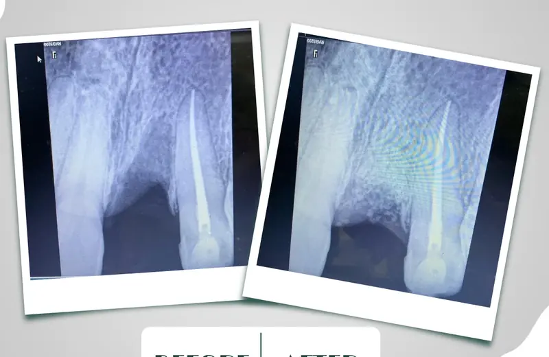 Socket preservation X-ray before and after at DENTIN Dental Clinic, HSR Layout