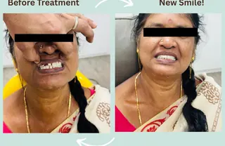 Zirconia bridge smile transformation at DENTIN Dental Clinic, HSR Layout