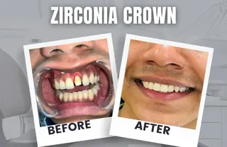 Zirconia crown before and after result at DENTIN Dental Clinic, HSR Layout Bengaluru