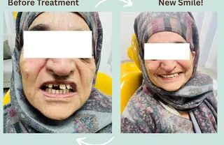 Zirconia crowns smile transformation at DENTIN Dental Clinic, HSR Layout