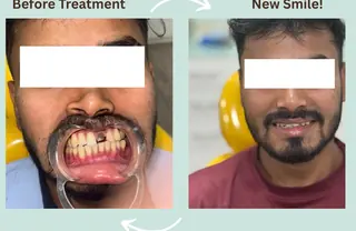 Zirconia crowns before and after result at DENTIN Dental Clinic, HSR Layout