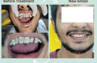 Zirconia crowns smile restoration at DENTIN Dental Clinic, HSR Layout
