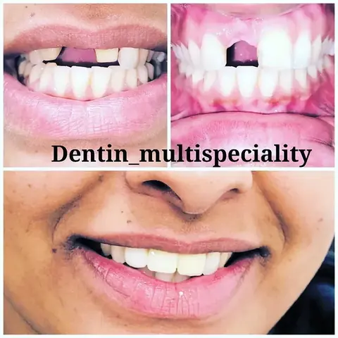 Aesthetic zirconia crown restoration at DENTIN Multispeciality Dental Clinic & Implant Center, HSR Layout Bengaluru