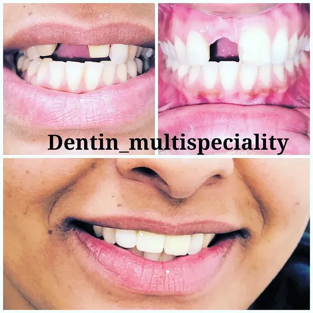 Missing front tooth restored with an aesthetic zirconia crown at DENTIN, HSR Layout Bengaluru
