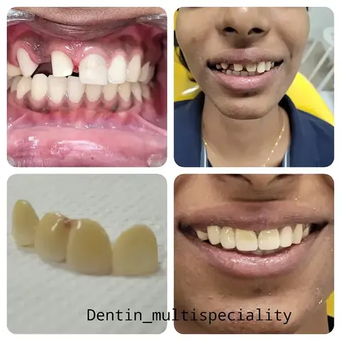Anterior dental bridge restoration at DENTIN Multispeciality Dental Clinic & Implant Center, HSR Layout Bengaluru