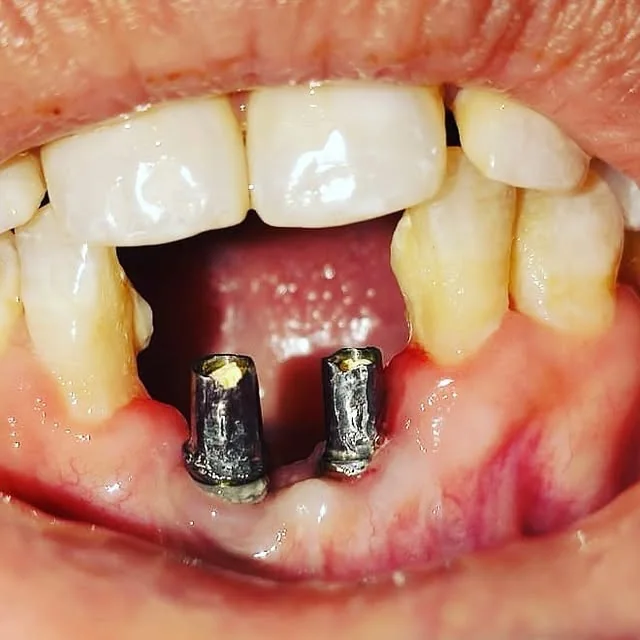 Anterior dental implant treatment at DENTIN Multispeciality Dental Clinic & Implant Center, HSR Layout Bengaluru