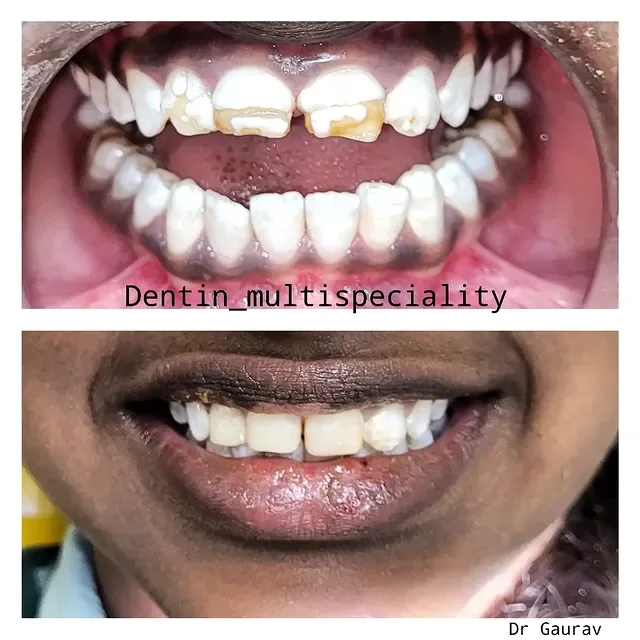 Anterior tooth-coloured restoration before and after at DENTIN, HSR Layout Bengaluru