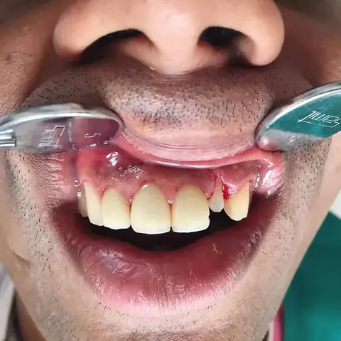 Crown lengthening by Dr. Kumar Gaurav at DENTIN Multispeciality Dental Clinic & Implant Center, HSR Layout Bengaluru