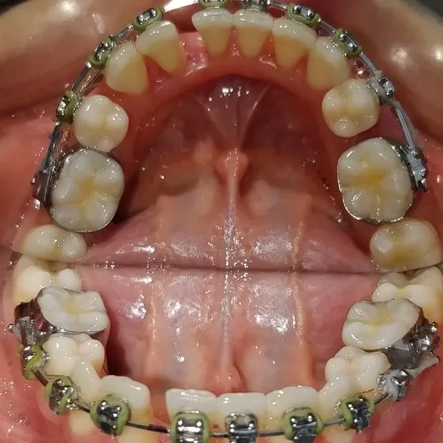 Dental braces treatment at DENTIN, HSR Layout Bengaluru