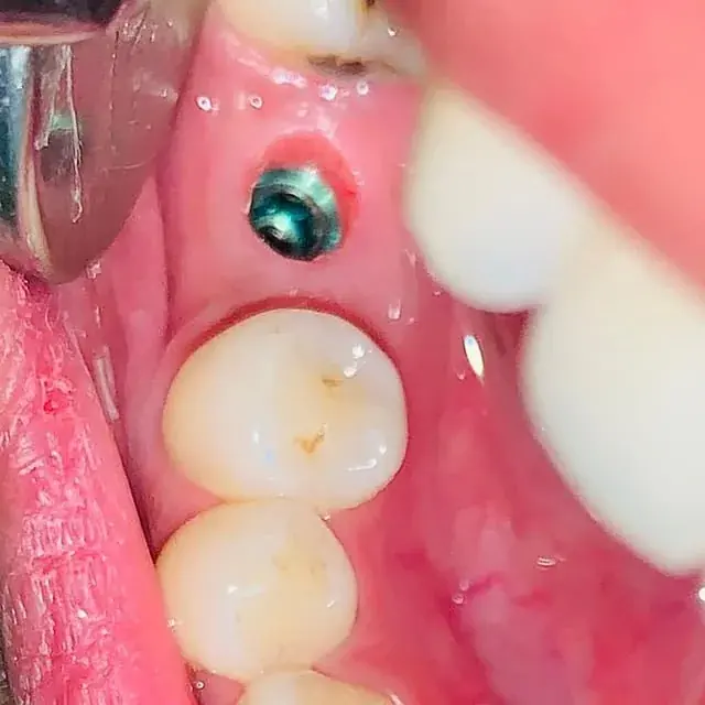 Dental implant gingival cuff treatment at DENTIN, HSR Layout Bengaluru