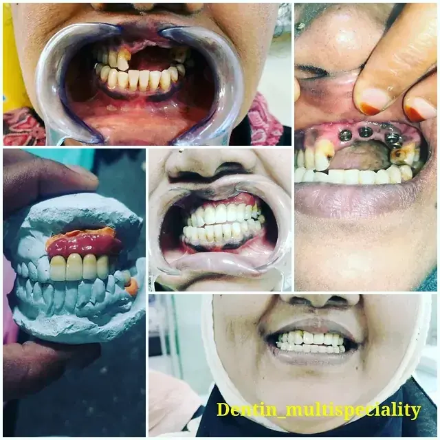 Dental implant ridge contouring at DENTIN Multispeciality Dental Clinic & Implant Center, HSR Layout Bengaluru