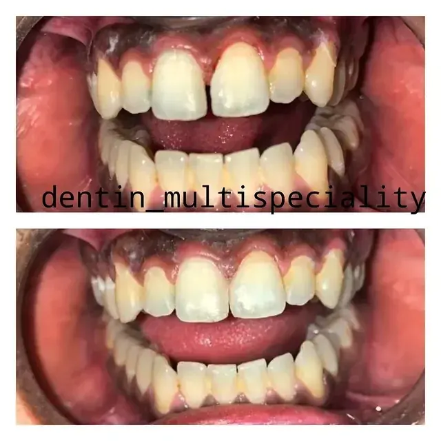Diastema closure smile makeover at DENTIN Multispeciality Dental Clinic & Implant Center, HSR Layout Bengaluru