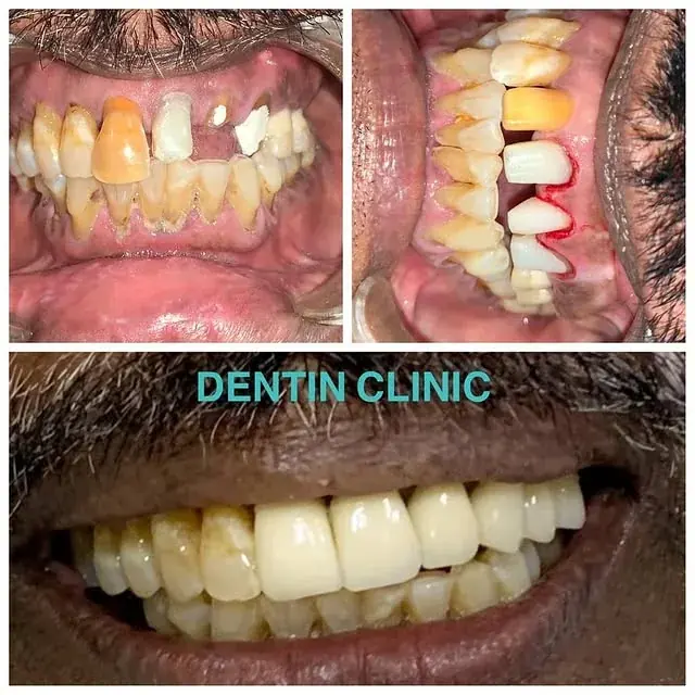 Digital smile designing at DENTIN Multispeciality Dental Clinic & Implant Center, HSR Layout Bengaluru