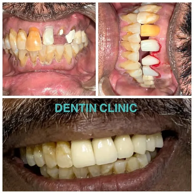 Smile design planning for brighter teeth at DENTIN Multispeciality Dental Clinic & Implant Center, HSR Layout Bengaluru