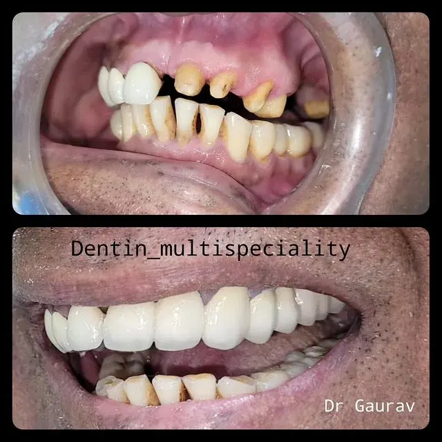 Full-mouth fixed dental restoration at DENTIN Multispeciality Dental Clinic & Implant Center, HSR Layout Bengaluru