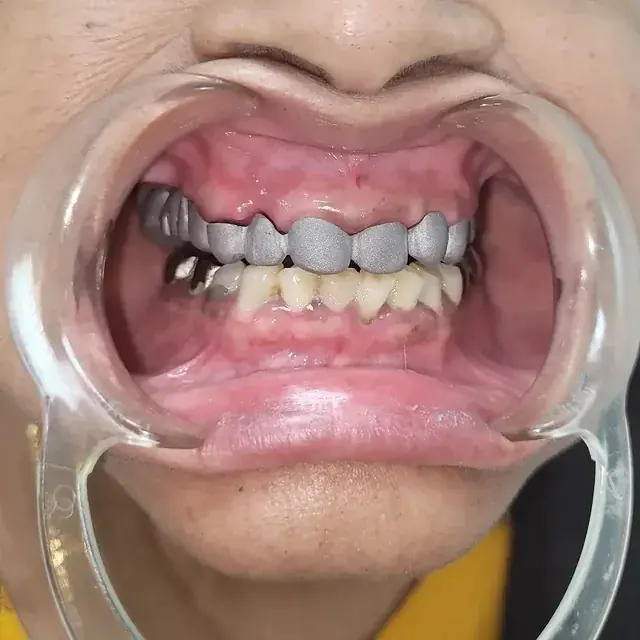 Full-mouth dental rehabilitation at DENTIN Multispeciality Dental Clinic & Implant Center, HSR Layout Bengaluru