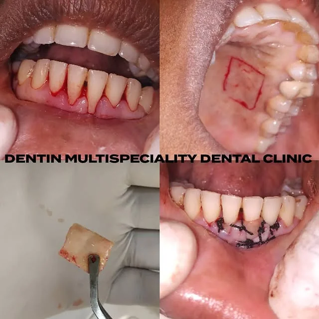 Periodontal gum treatment at DENTIN, HSR Layout Bengaluru