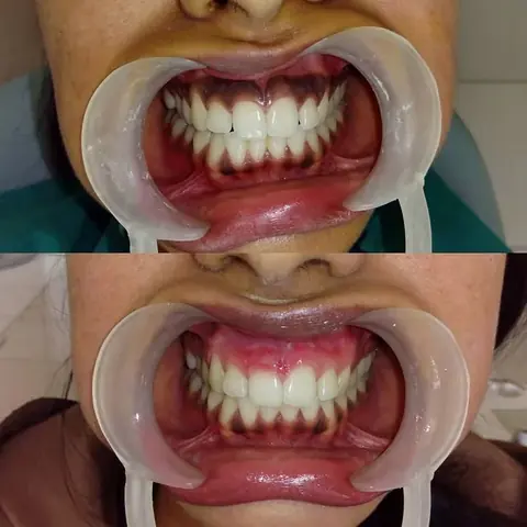 Gum depigmentation before and after at DENTIN Multispeciality Dental Clinic & Implant Center, HSR Layout Bengaluru