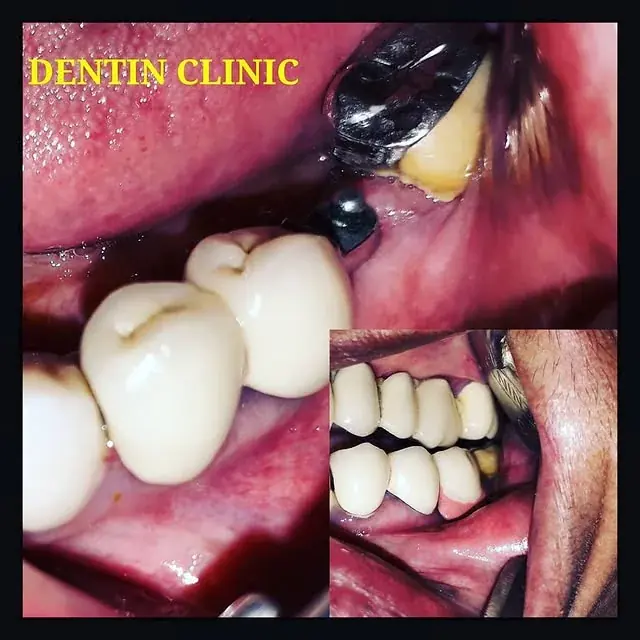 Precision attachment option for missing teeth at DENTIN, HSR Layout Bengaluru