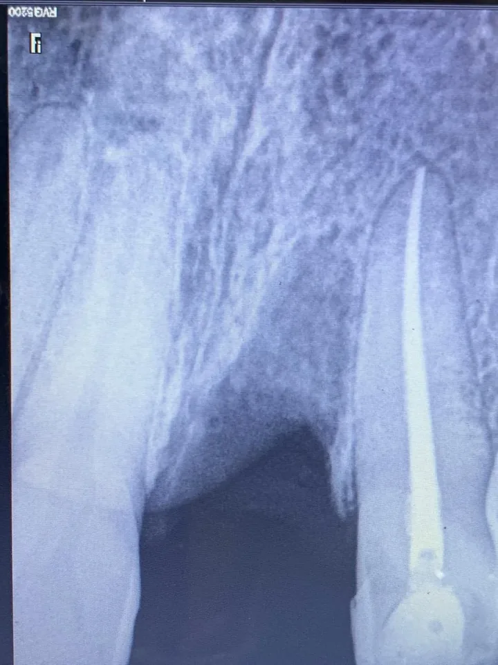 Root canal treatment clinical result at DENTIN Multispeciality Dental Clinic & Implant Center, HSR Layout Bengaluru