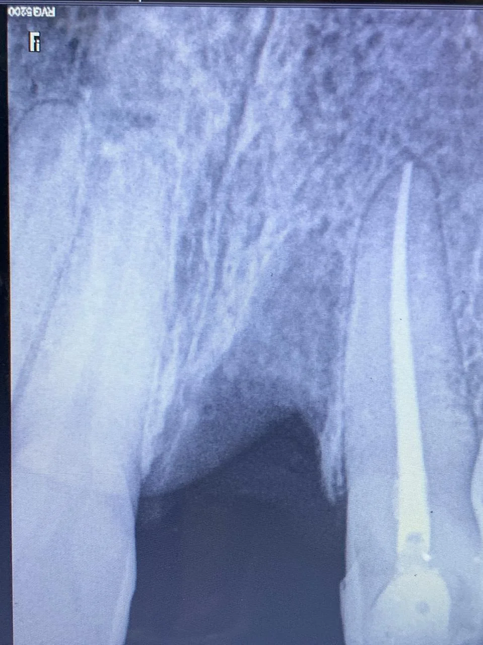 Root canal treatment at DENTIN Multispeciality Dental Clinic & Implant Center, HSR Layout Bengaluru