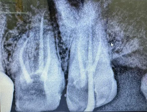 Root canal X-ray at DENTIN Multispeciality Dental Clinic & Implant Center, HSR Layout Bengaluru