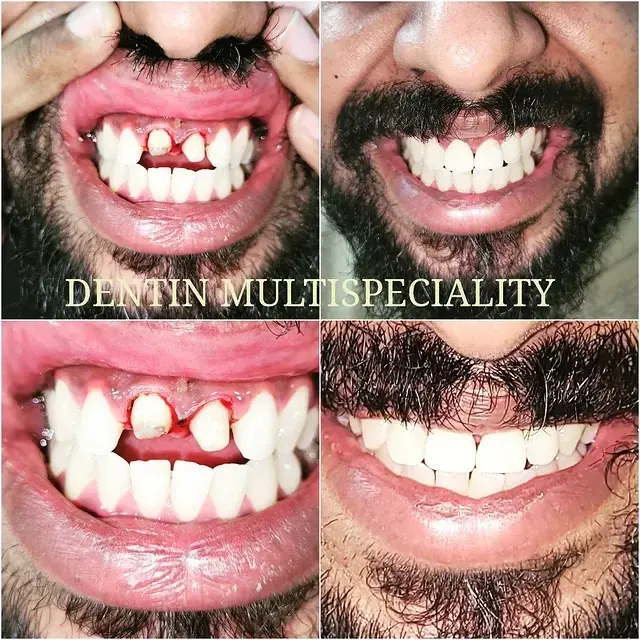 Zirconia crown smile makeover at DENTIN Multispeciality Dental Clinic & Implant Center, HSR Layout Bengaluru