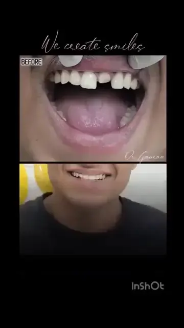 Digital smile design at DENTIN in HSR Layout