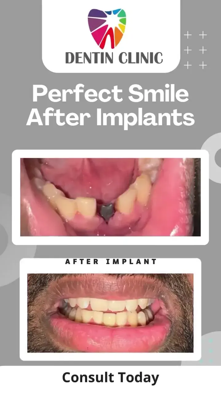 Patient smile after dental implant treatment at DENTIN