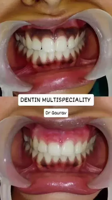 Laser gum depigmentation at DENTIN in HSR Layout