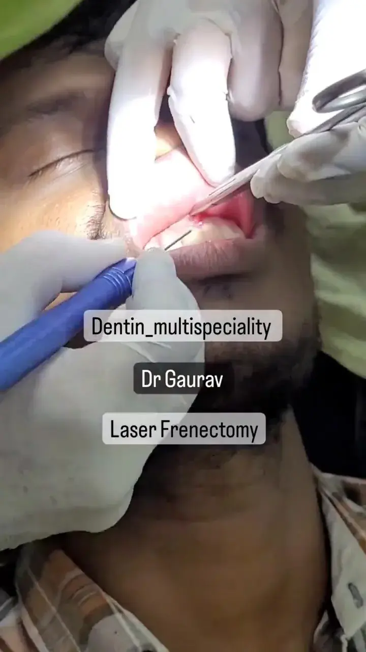 Laser frenectomy by Dr. Kumar Gaurav at DENTIN