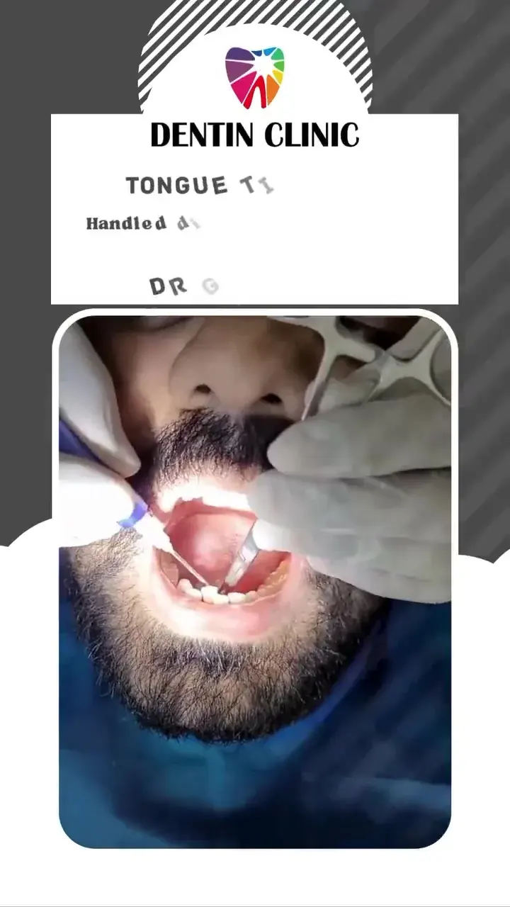 Tongue-tie laser treatment by Dr. Kumar Gaurav at DENTIN