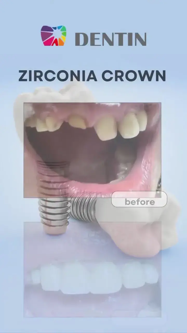 Zirconia dental crowns at DENTIN in HSR Layout